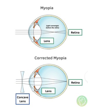 Myopia diagram