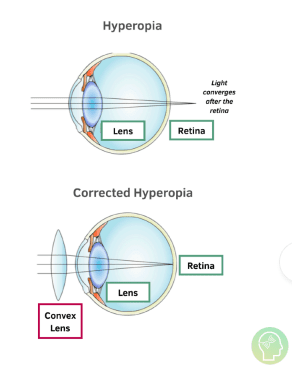 Hyperopia diagram